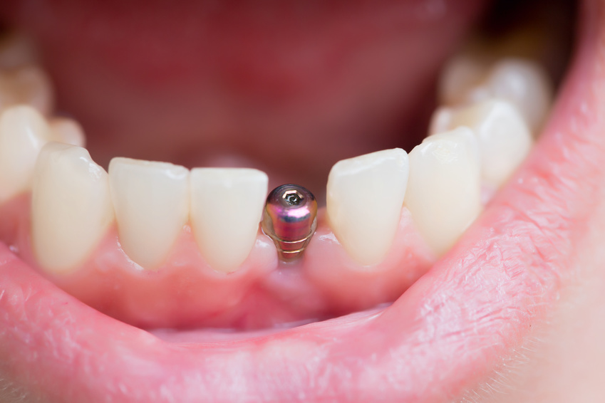 Qu'est-ce qu'une restauration complète de la bouche